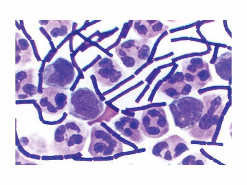 Gram-positive Bacillus anthracis bacteria (purple rods) in cerebrospinal fluid sample. The other cells are white blood cells