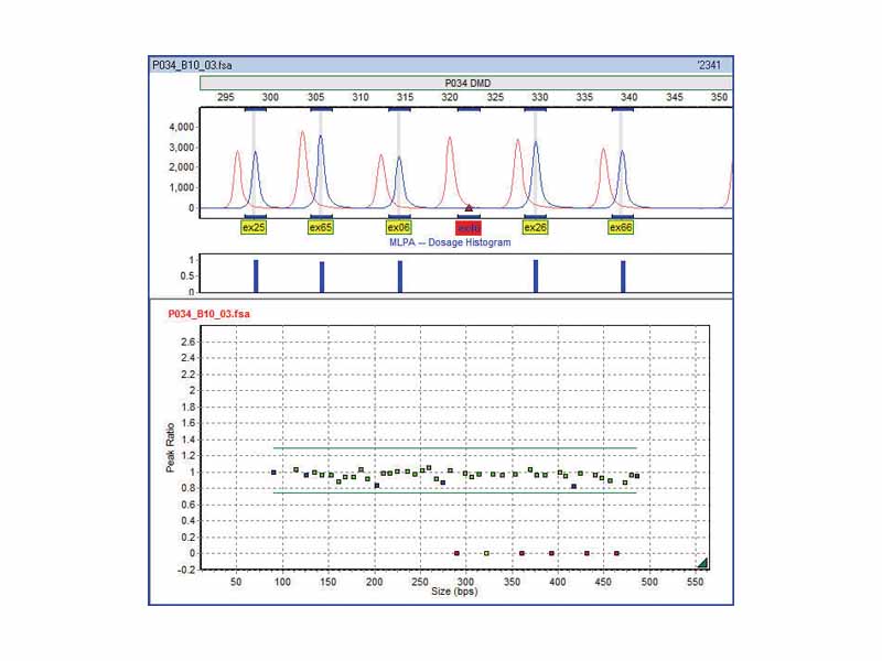 Example of exon deletions detected by MLPA in a Duchenne Muscular Dystrophy (DMD) patient