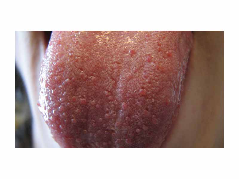 Close-up view of a tongue with visible fungiform papillae (large bumps) scattered among filiform papillae (small bumps).