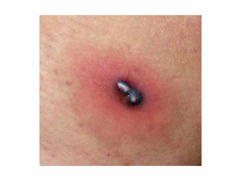 An abscess on the skin, showing the redness and swelling characteristic of inflammation. Black rings of necrotic tissue surround central areas of pus