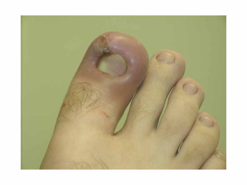 Infected ingrown toenail showing the characteristic redness and swelling associated with acute inflammation
