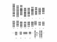 Karyotype for trisomy Down syndrome. ...